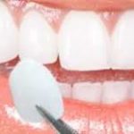 types facette dentaire